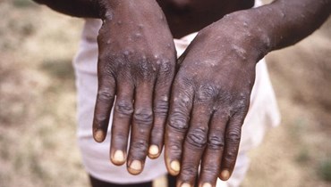 صورة تعود لعام 1997 وتظهر يدي مريض مصاب بجدرى القردة في جمهورية الكونغو الديمقراطية (أ ب). 